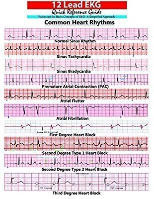 Ekg Rhythms, Cardiology Nursing, Ekg Interpretation, Paramedic School, Nursing Cheat, Nursing Mnemonics, Cardiac Nursing, Critical Care Nursing, Nursing School Survival