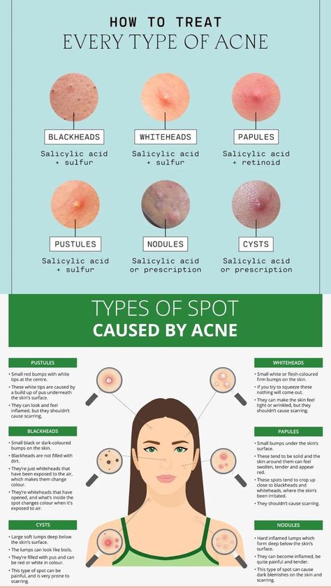 hair health products Different Types Of Acne, Forehead Acne, Bad Acne, Blackheads On Nose, Skin Advice, Basic Skin Care, Natural Acne Remedies, Types Of Acne, Acne Causes