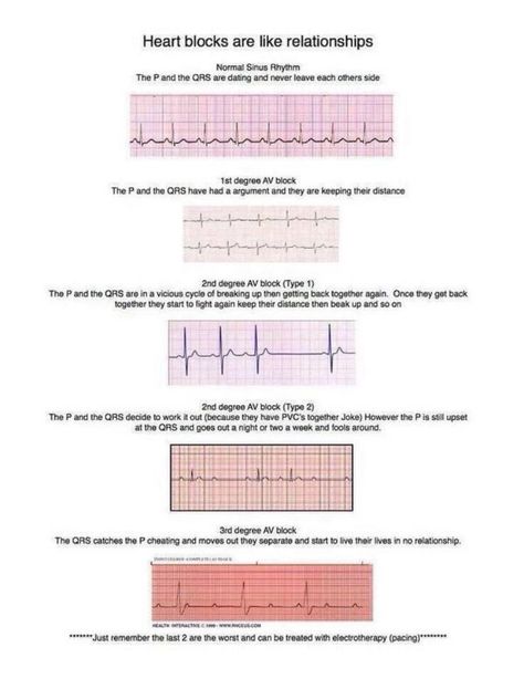 Heart blocks made easy:) Ekg Interpretation, Ems Humor, Nursing Fun, Heart Blocks, Nursing Humor, Cardiac Nursing, Critical Care Nursing, Nursing Life, Nurse Rock