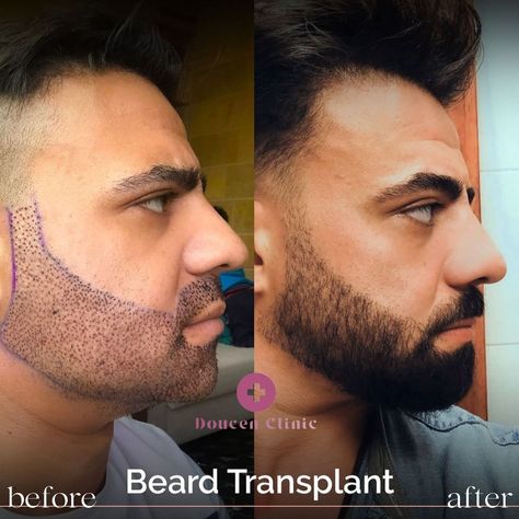 Upgrade your look with our beard transplant service. Say goodbye to patchy spots and hello to a full, luscious beard. Embrace a new level of confidence and style. Book your transformation today! 👨💪 #BeardTransplant Beard Transplant, Upgrade Your Look, March 17, Confidence, Books, Quick Saves, Instagram