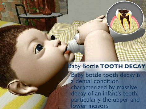 Baby Bottle Tooth Decay: Baby bottle tooth decay is a dental condition characterized by massive decay of an infant's teeth, particularly the upper and lower incisors Baby Bottle Tooth Decay, Pediatric Dentistry, Baby Bottle, Tooth Decay, Baby Bottles, Pediatrics, Conditioner