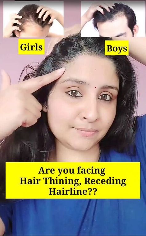 Do you have bald patches, thinning hair, or big forehead problems? For the recipe and application tips, follow along with this simple tutorial. How To Grow Hair From Bald, Forehead Hair Growth Tips, Forehead Hair Growth, Grow Baby Hair, Get Long Hair Fast, Hair Growth At Home, Coffee Shampoo, Hair Growth Long, Bald Hair Growth