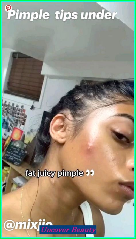 ✨ Perfect Skin – The Comprehensive Solution for All Your Needs! popping blackheads, how to get rid of pimples overnight, how to get rid of blackheads 📌 Please Comment, Like, or Re-Pin for later 😍💞 #skincaretips #glowingskin #beautyhacks How To Get Rid Of Pimples Overnight, Getting Rid Of Pimples, Neck Pimples, Blackheads On Cheeks, Clear Pimples, Redness Pimple, Get Rid Of Pimples Overnight, Rid Of Pimples Overnight, Acne Prevention