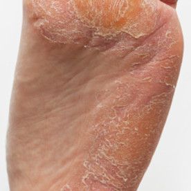 Foot Fungus Remedies, Nail Remedies, Toenail Fungus Remedies, Nails Healthy, Nail Infection, Fungal Nail, Athletes Foot, Ingrown Toe Nail, Stained Teeth