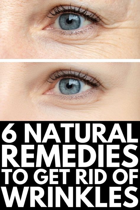 Hair Fall Remedies, Wrinkles On Forehead, Home Remedies For Wrinkles, Hair Fall Remedy, Wrinkle Remedies, Eye Wrinkles, Get Rid Of Wrinkles, Skin Wrinkles, Natural Beauty Remedies