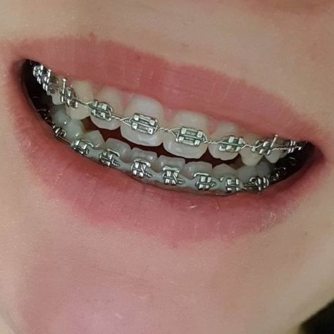 Perfect Teeth Braces, Pink Braces, Smile Tips, Silver Braces, Braces Smile, Cute Braces Colors, Pretty Teeth, Braces Tips, Getting Braces