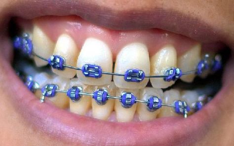 I just got result 'Purple!!' on quiz 'What colour train track braces should I get?'. What will you get? Dark Blue Braces, Purple Braces, Diy Braces, Fake Braces, Braces Smile, Cute Braces Colors, Braces Cost, Types Of Braces, Braces Tips