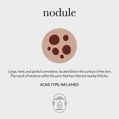 Of all inflamed acne, the Nodule is the deepest of all the acne types. This inflamed breakout is hard to the touch and can vary in color. They often appear as large, flesh colored bumps on the skin. Other times they’ll appear more red and inflamed. Regardless of how they look, nodules feel hard to the touch and feel like a dense bump rooted beneath the skin. Much like To prevent and treat these inflamed breakouts do not skip your acne med or exfoliating serum. Book a consultation today! Face Reality Skincare, Nodule Acne, Acne Types, Exfoliating Serum, Face Reality, Healthy Life Hacks, Types Of Acne, Instagram Bio Quotes, Cystic Acne