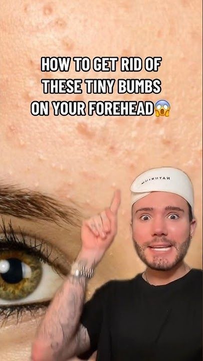 HOW TO GET RID OF FORHEAD BUMPS!😱(follow for more💗) #skincare #acne #skin #skincareroutine #beauty How To Get Rid Of Pimple Bumps On Face, Bumps On Face How To Get Rid Of, How To Get Rid Of Heat Bumps On Face, Bumpy Forehead Remedy, How To Get Rid Of Big Pimples, How To Get Rid Of Pimples Quick, Skincare Routine To Get Rid Of Acne, How To Remove Small Bumps On Face, How To Get Rid Of Spots