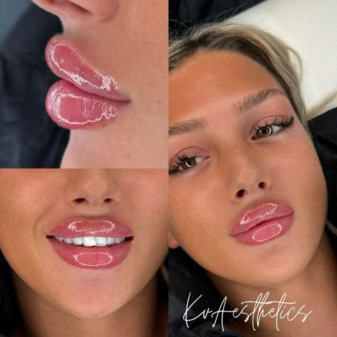 Katherine Victoria on Instagram: "Bratz Doll Lips 💋  @caitlinsherwoodx   This Is Your Sign 💫 1ml Refresh 💞  Sunderland Aesthetics @kvaestheticsuk   Get booked In This Week 📲  Refresh Starting From £100   ✨✨✨Thank you EVERYONE for spreading your positive vibes out there. ✨✨✨" Bratz Lip Filler, Bratz Doll Lip Filler, Doll Lips Filler, Bratz Doll Lips, Lip Filler Shapes, Face Make Up Ideas, Bratz Lips, 1ml Lip Filler, Doll Lips