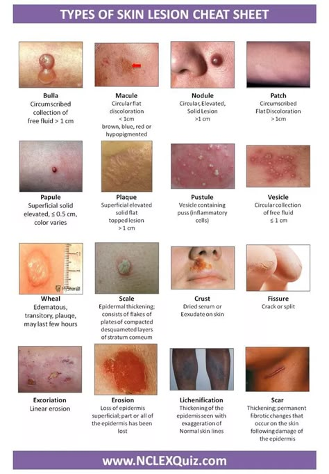 MEDizzy - Types of Skin Lesion Cheat Sheet Anatomy Revision, Wound Care Nursing, Np School, Skin Lesions, Nurse Practitioner School, Nursing Information, Nursing Cheat, Nursing Assessment, Community Nursing