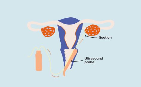 Getting real about IVF success rates (and the factors that impact them) Fertility Illustration, Modern Fertility, Planning For A Baby, Ivf Success Rates, Assisted Reproductive Technology, Egg Quality, Starting A Family, Ivf Cycle, Ivf Success