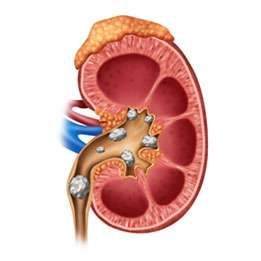 Normocalcemic primary hyperparathyroidism (nPHPT) Renal Physiology, Renal System, Stone Aesthetic, Kidney Healthy Foods, Uric Acid Levels, Urinary System, Robotic Surgery, Kidney Stone, Uric Acid