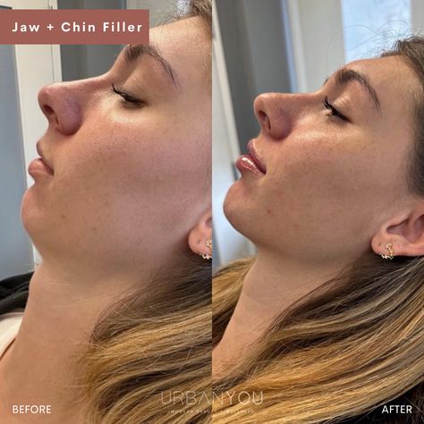 Jaw + Chin Filler | Before and After Small Jawline Faces, Chin Shapes, Small Lips With Filler, Jawline And Chin Filler, Jaw Contour, Jaw And Chin Filler Before And After, Types Of Jawlines Women, Jaw And Chin Filler, No Jawline Women