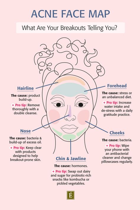 Acne Face Map, Face Map, Face Mapping Acne, Forehead Acne, Eminence Organic Skin Care, Face Mapping, Skin Advice, Basic Skin Care, Natural Acne Remedies