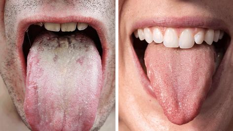 Researchers Explain What The Color of Your Tongue Says About Your Health Nails Remedies, Healthy Tongue, Remedies For Dry Mouth, White Tongue, Heath Tips, Sunburn Relief, Coconut Health Benefits, Tongue Health, Dry Mouth