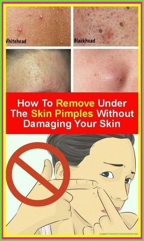 Under The Skin Pimples, To Remove Pimples, Remove Pimples, Pimples Under The Skin, Body Coach, Under The Skin, Face Creams, How To Remove Pimples, Acne Cream