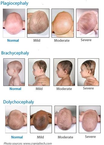 diagram of different levels of flat heads on baby Baby Head Shape, Flat Head Syndrome, Nursing School Essential, Baby Routine, Newborn Baby Tips, Newborn Mom, Nursing School Survival, Medical School Essentials, Baby Facts