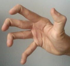 HYPERMOBILITY in Fibromyalgia: Yes, I have always been Hypermobile. Researchers trying to fathom the causes of this painful condition Double Jointed Fingers, Waiting For Guffman, Martin Mull, Fat Loss Muscle Gain, Restless Legs Syndrome, Love Hands, Mast Cell Activation, Trucking Company, Histamine Intolerance