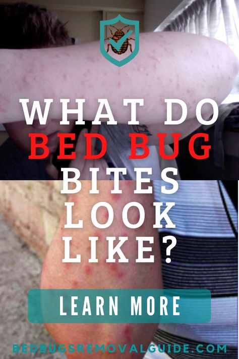 The bites of bed bugs can be mistaken as other household insects because the bites appear like those caused by other insects like fleas, mosquitoes, and lice. However, bed bug bites can be identified when you know the symptoms to look out for. 👉 Learn more. Bed Bug Bites Pictures, Sand Fleas, Kill Bed Bugs, Rid Of Bed Bugs, Bed Bug Bites, Spider Bites, Holistic Diet, Diy Cleaning Solution, Bed Bug