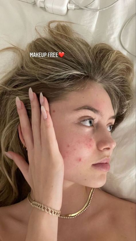 Girl With Acne Aesthetic, Girl With Acne, Leni Klum, Makeup Free, Bare Beauty, Bare Face, Facial Skin Care Routine, Love Your Skin, Pretty Skin