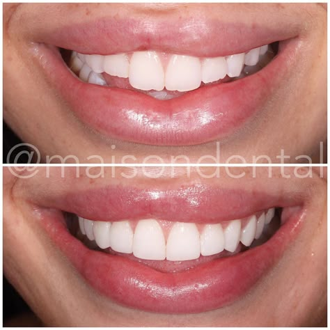 Maison Dental on Instagram: “One from the London clinic 💥 ⠀⠀⠀⠀⠀⠀⠀⠀⠀ This case was a combination of composite edge bonding on the front 6 teeth and composite veneers on…” Edge Bonding Teeth Before And After, Composite Edge Bonding Teeth, Composite Bonding Teeth Before And After, Edge Bonding Teeth, Composite Veneers Before And After, Teeth Bonding Before And After, Composite Bonding Teeth, Teeth Composite, Perfect Teeth Smile