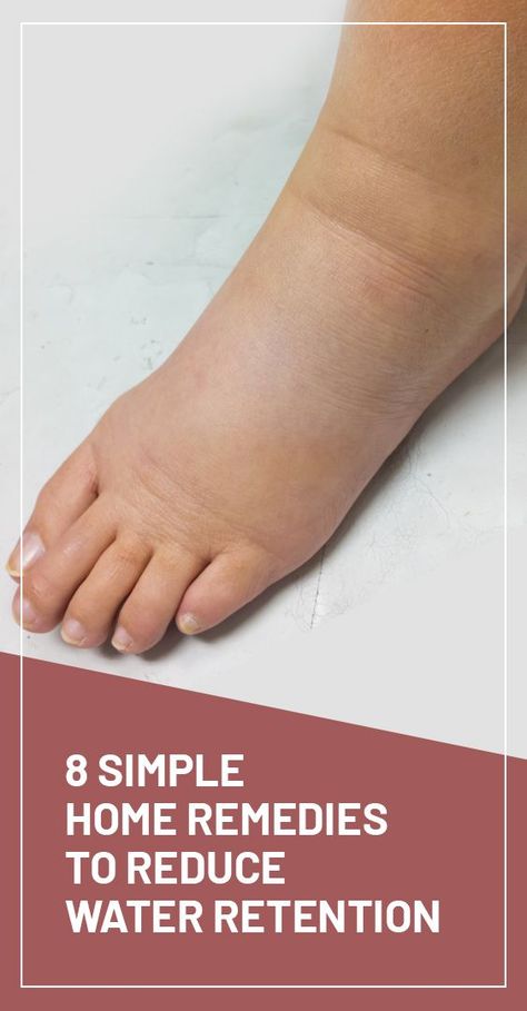 Fluid Retention Remedies, Swelling Remedies, Water Retention Remedies, Blood Sugar Tracker, Blood Sugar Solution, Swollen Legs, Blood Sugar Diet, Health And Fitness Magazine, Fluid Retention