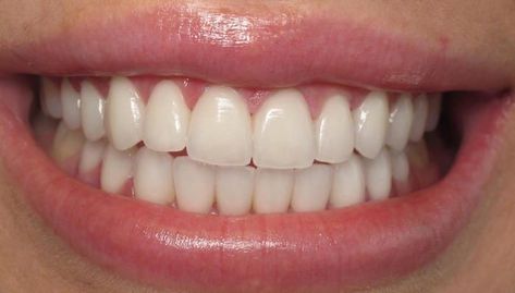 Crush Signs, Teeth Aesthetic, Pretty Teeth, Beautiful Teeth, Wish Board, Porcelain Veneers, Perfect Teeth, Vision Board Images, Smile Teeth