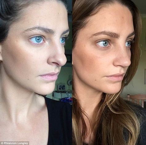 Before and after: The 24-year-old social media star kept a journal of her operation, which fixed her hanging columella, a drooping tip, and shaved down the bridge of her nose Persian Nose, Polish Nose, Jaw Reduction Surgery, Rhinoplasty Recovery, Surgery Nose, V Line Surgery, Plastic Surgery Fail, Korean Plastic Surgery, Job Images