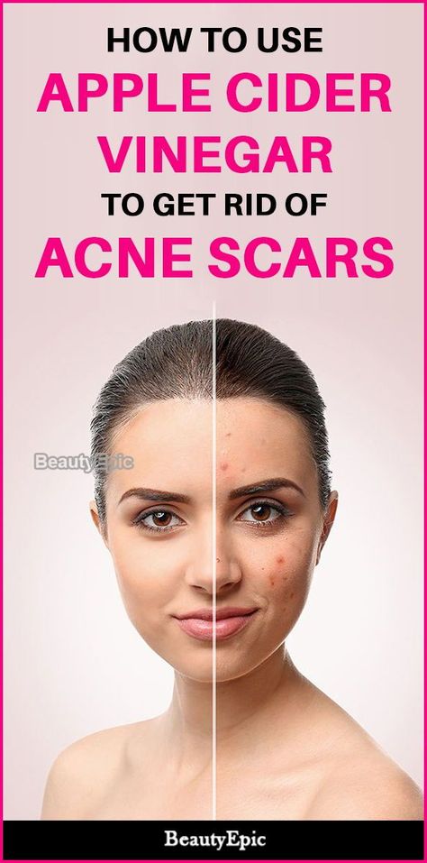 How to use Apple Cider Vinegar To Get Rid Of Acne Scars Brown Age Spots, Brown Spots On Skin, Spots On Skin, Remedies For Acne, Skin Care Routine For 20s, Dark Spots On Face, Brown Spots Removal, Natural Acne Remedies, Brown Spots On Face