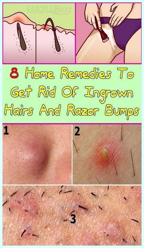 Great Trick With Which You Will No Longer Have Ingrown Hairs After Shaving Treat Ingrown Hair, Ingrown Hair Remedies, Skin Bumps, Skin Care Routine For 20s, Hair Growing, Unwanted Facial Hair, Hair Curls, Ingrown Hairs, Razor Bumps