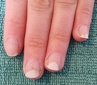 Fungal Nail Fungi Pictures, Healthy Fingernails, White Spots On Nails, Fingernail Health, Nail Disorders, Nail Remedies, Fingernail Fungus, Nail Conditions, Opi Gel Nails