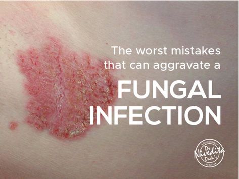 Fungal infection is an infectious skin condition  leading to irritation, scaly skin, redness, itching, swelling, and blisters. It can take place anywhere on the body. Once fungal infection is acquired, it takes quite some time to get rid of it.    Read the blog and find out the worst mistakes that can aggravate a fungal infection Staphylococci Bacteria Infection On Skin, Skin Rash Remedies, Fungal Rash, Fungal Infection Remedies, Skin Fungus, Rashes Remedies, Fungal Infection Skin, Nose Picking, Sick Remedies