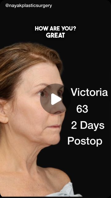 Facial Lipo Before And After, Lip Lift Surgery Before And After, Deep Plane Facelift, Lipo Before And After, Face Plastic Surgery, Facelift Before And After, Face Laser, Lip Lift, Healing Skin