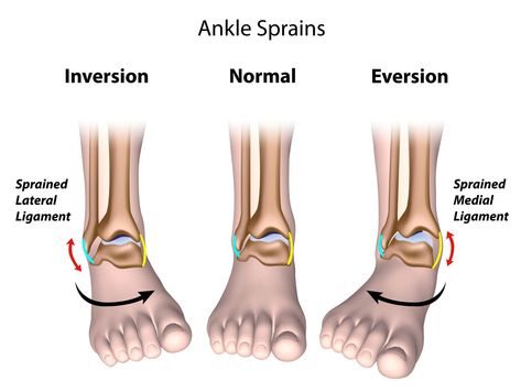 Sprained Ankle Exercises, Ankle Break, Ankle Sprain Recovery, Ankle Rehab, Fitness Recovery, High Ankle Sprain, Ankle Ligaments, Ankle Fracture, Ankle Exercises