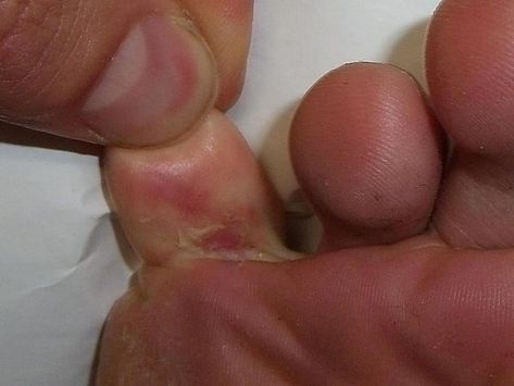 Candida Yeast Infection, Toenail Fungus Remedies, Nail Fungus Remedy, Fungal Nail, Athletes Foot, Toenail Fungus, Nail Fungus, Foot Care, Natural Home Remedies