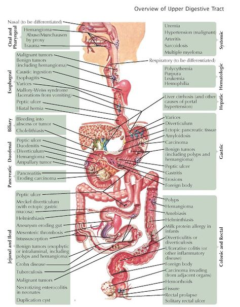 Overview of  Gastrointestinal Bleeding   Bleeding is a common symptom of both benign and malignant disorders of the digestive system. Ble... Nursing Study Guide, Gastrointestinal System, Gastrointestinal Disorders, Nuclear Medicine, Pa School, Nursing School Studying, Medical School Studying, Medical Coding, Medical Anatomy