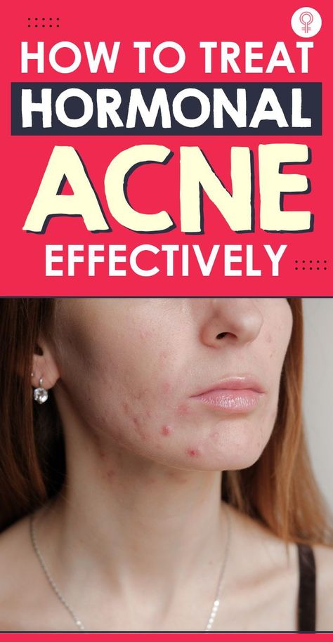 Skin Treatments For Acne, Treat Hormonal Acne, Treatments For Acne, Back Acne Remedies, Face Map, Chin Acne, Acne Prone Skin Care, Bad Acne, Get Rid Of Pimples