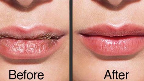 How To Heal Dry And Cracked Lips | Home remedies for dry lips in winter | MS Health and Beauty #drylips #drylipsremedy #drylipstreatment #dryandcrackedlips ... Remedies For Dry Lips, Dry Lips Remedy, Zit Remedy, Remedies For Dark Lips, Dry Cracked Lips, Bb Glow, Wax Strips, Cracked Lips, Peeling Skin