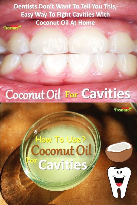 Coconut Oil For Cavities: Heal Cavities With Coconut Oil, Oil Pulling, How To Use Coconut Oil For Cavities, How To Get Rid Of Cavities. Dentists don’t want to tell you this, easy way to fight cavities with coconut oil at home. Easy Home #Remedies For Cavit self care tips #beauty Home Remedies For Cavities, Reverse Cavities, Heal Cavities, Hair Overnight, Coconut Oil For Hair, Coconut Oil For Teeth, Oil Hair Mask, Coconut Oil For Acne, Dental Cavities