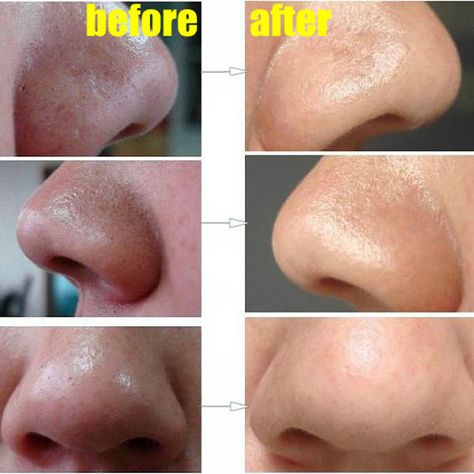 We all struggled with blackheads at one point in our life and we have to admit that they are not aesthetic. All that dirt, oil and sebum that is sticking Blackheads On Nose, Get Rid Of Blackheads, Beauty Remedies, Homemade Beauty Products, Blackhead Remover, Health And Beauty Tips, Beauty Treatments, Belleza Natural, Facial Care