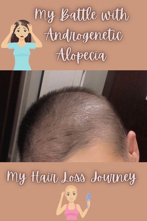 Grow Hair Back, Alopecia Hair Growth, Alopecia Hairstyles, Androgenic Alopecia, Traction Alopecia, Female Pattern Baldness, Androgenetic Alopecia, Baking Soda Cleaning, Loss Hair