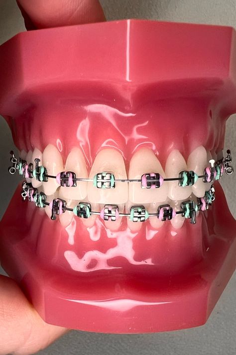 Braces Colors Combinations Summer, Pink And Green Braces, Green Braces Color, Braces Band Colors, Mint Green Braces, Summer Braces Colors, Light Pink Braces, Braces Combos, Braces Color Combos