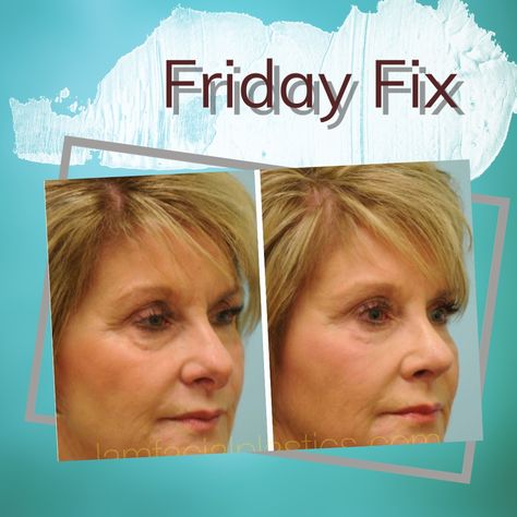 FRIDAY FIX: This woman underwent a revision (corrective) rhinoplasty with Dr. Sam Lam after experiencing a failed attempt at previous rhinoplasty.  She is shown before and after her surgery that required a hump reduction, tip refinement, and tongue-in-groove technique to improve the relationship between the ala and the columella (hanging columella). Revision Rhinoplasty, Failed Attempt, The Shape, Surgery, Conditioner