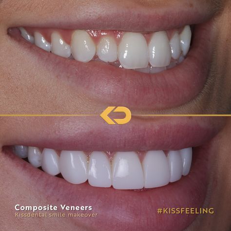 How incredible is this composite veneer makeover?! This patient was looking for a brighter more symmetrical smile. The Dr placed 8 composite veneers to complete the look. Book in for a FREE consultation at any of our clinics: 📍Manchester City centre 📍Flixton 📍Altrincham 📍Knutsford 📍Alderley Edge 📍Liverpool Head to kissdental.co.uk to get booked in Dental Cover, Composite Bonding, Cosmetic Dentistry Veneers, Composite Veneers, Alderley Edge, Dental Fillings, Aesthetic Dentistry, Dental Tourism, Porcelain Veneers