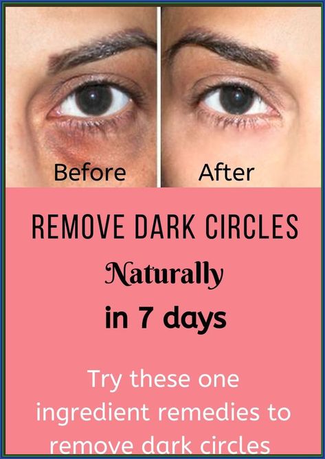 REMOVE DARK CIRCLES UNDER EYES IN 7 DAYS !!! Healthy Heart Tips, Cleaning Your Ears, Gourmet Salt, Chest Congestion, Eating Good, Health Signs, Estrogen Dominance, Remove Dark Circles, Feminine Health