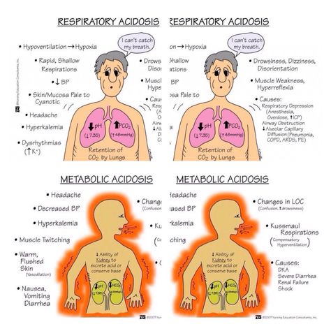 Metabolic Acidosis/Respiratory Acidosis Acidosis And Alkalosis, Respiratory Acidosis, Metabolic Acidosis, Med Surg Nursing, Nursing Mnemonics, Surgical Nursing, Nursing School Survival, Critical Care Nursing, Respiratory Therapy