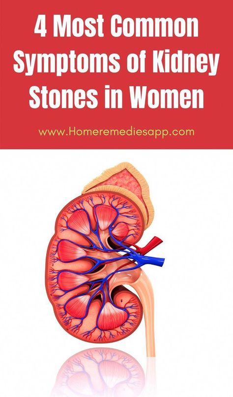 10 Home Remedies for Kidney Stones - The most common reason for the formation of kidney stones is a lack of water in the body. Natural Antibiotic, Kidney Stone, Holistic Health Remedies, Natural Colon Cleanse, Health Living, Turmeric Curcumin, Natural Antibiotics, Baking Soda Shampoo, Natural Cough Remedies