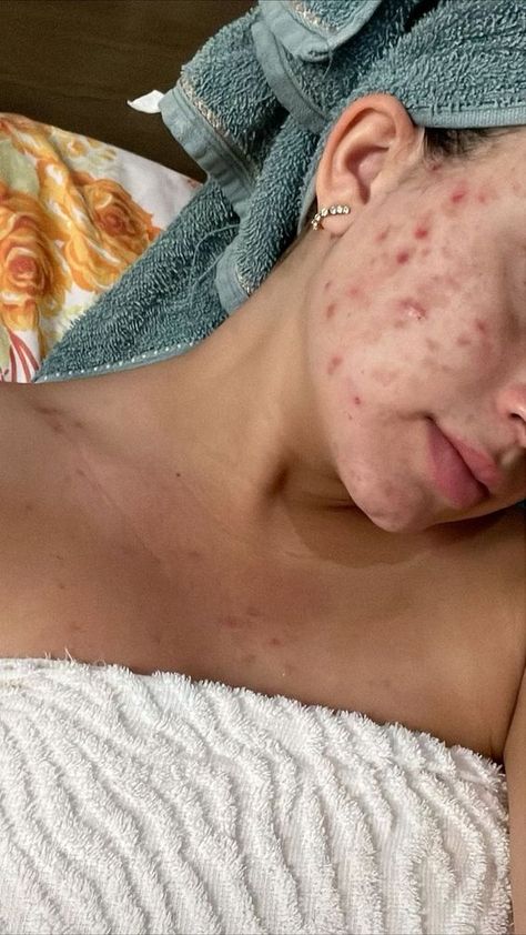 Acne Face Aesthetic, Bad Skin Pictures, Body Acne Positivity, Acne Aesthetic Girl, Pimples Aesthetic, Acne Skin Aesthetic, Bad Acne Pictures, Girls With Acne, Acne Appreciation