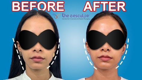 Dr. Heena Kudyar is Talking about what is facial asymmetry, what are the causes of Asymmetrical Face and how to fix Asymmetrical Face. Facial Asymmetry, Asymmetrical Face, Facial Exercise, Facial Exercises, Facial, Projects To Try, Sunglasses, Skin